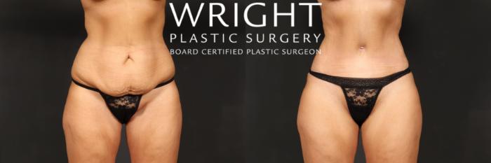 Before & After Tummy Tuck Case 552 Front View in Little Rock, Arkansas