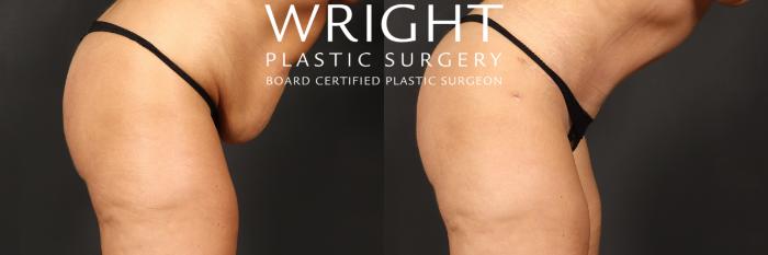 Before & After Tummy Tuck Case 552 Right Side View in Little Rock, Arkansas