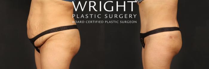 Before & After Tummy Tuck Case 557 Left Side View in Little Rock, Arkansas