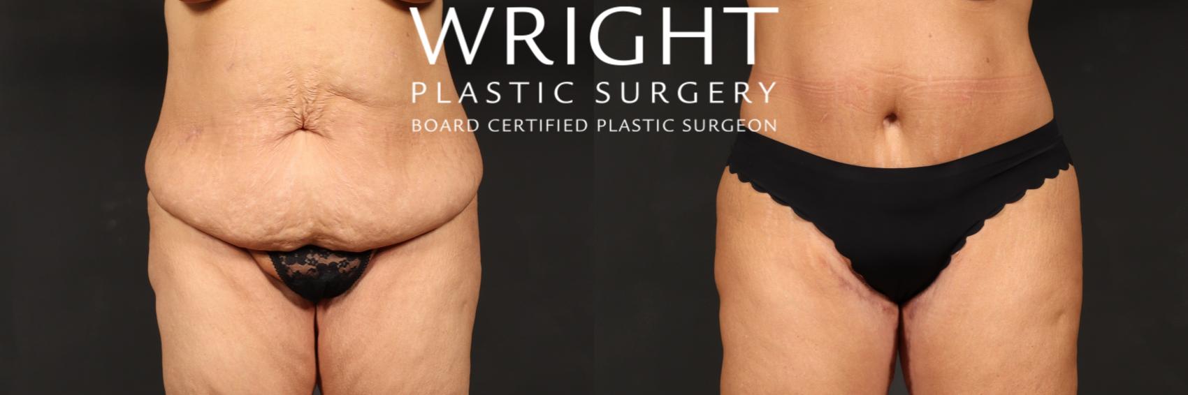 Before & After Tummy Tuck Case 558 Front View in Little Rock, Arkansas