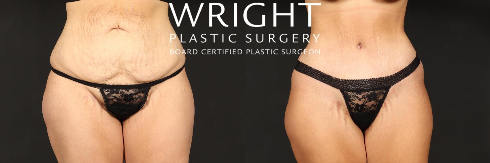 Before & After Tummy Tuck Case 560 Front View in Little Rock, Arkansas