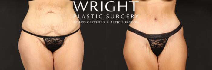 Before & After Tummy Tuck Case 560 Front View in Little Rock, Arkansas