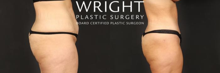 Before & After Tummy Tuck Case 560 Right Side View in Little Rock, Arkansas