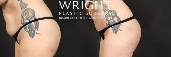 Before & After Tummy Tuck Case 563 Left side bending over View in Little Rock, Arkansas