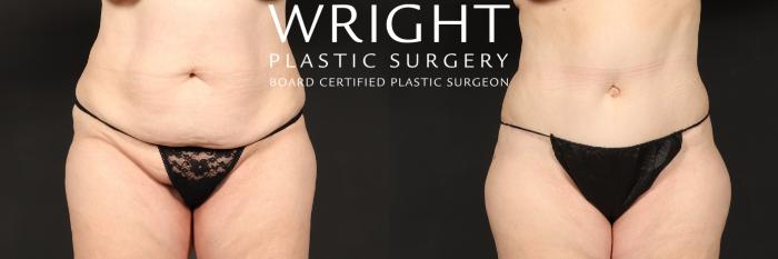 Before & After Tummy Tuck Case 569 Front View in Little Rock, Arkansas