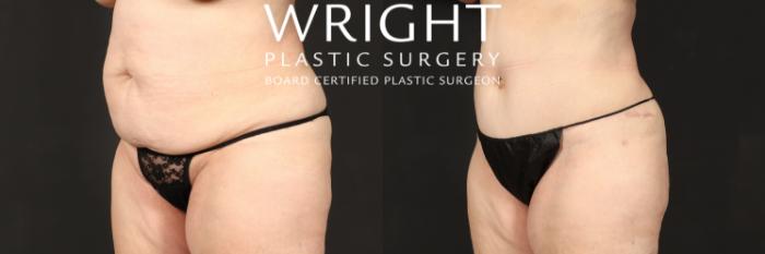 Before & After Tummy Tuck Case 569 Left Oblique View in Little Rock, Arkansas