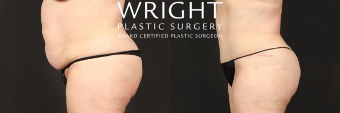 Before & After Tummy Tuck Case 569 Left Side View in Little Rock, Arkansas