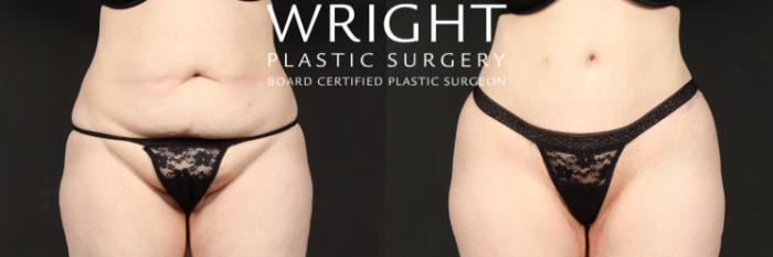 Before & After Tummy Tuck Case 577 Front View in Little Rock, Arkansas