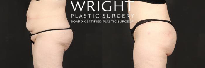 Before & After Tummy Tuck Case 577 Left Side View in Little Rock, Arkansas