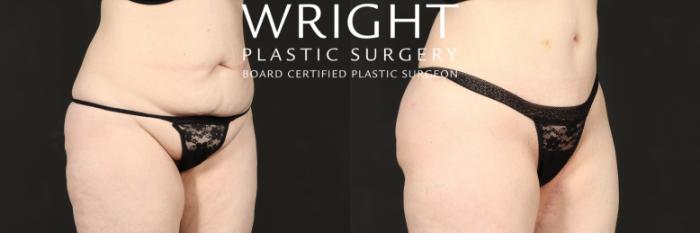 Before & After Tummy Tuck Case 577 Right Oblique View in Little Rock, Arkansas