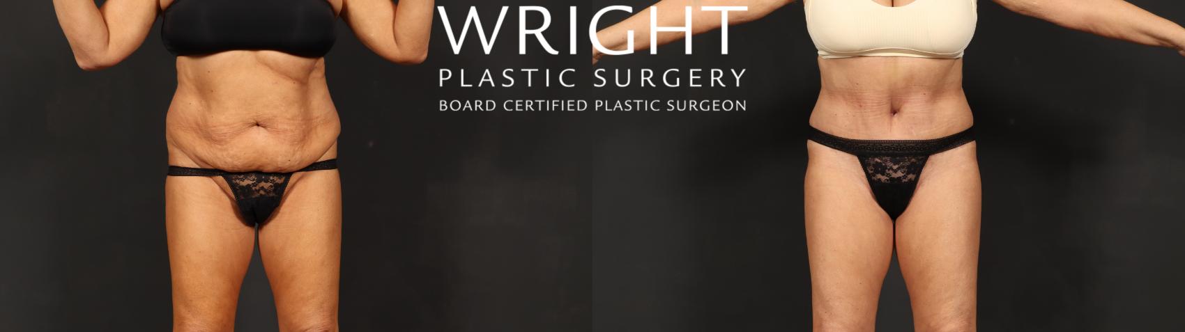 Before & After Tummy Tuck Case 592 Front View in Little Rock, Arkansas