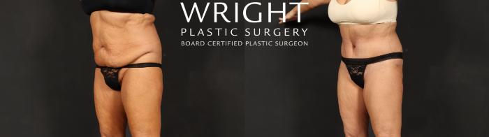 Before & After Tummy Tuck Case 592 Left Oblique View in Little Rock, Arkansas