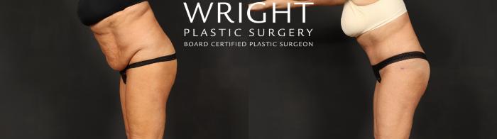 Before & After Tummy Tuck Case 592 Left Side View in Little Rock, Arkansas