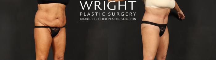Before & After Tummy Tuck Case 592 Right Oblique View in Little Rock, Arkansas