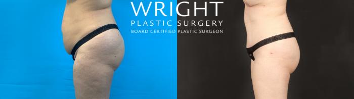 Before & After Tummy Tuck Case 593 Left Side View in Little Rock, Arkansas