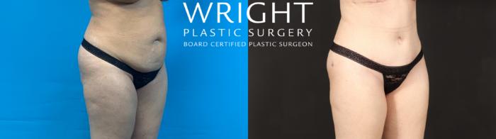 Before & After Tummy Tuck Case 593 Right Oblique View in Little Rock, Arkansas