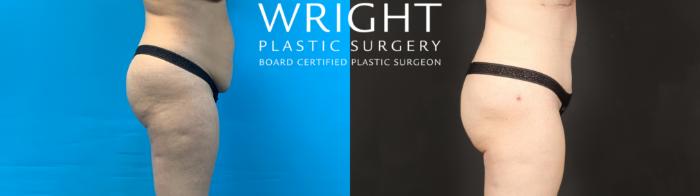 Before & After Tummy Tuck Case 593 Right Side View in Little Rock, Arkansas
