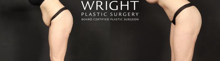 Before & After Tummy Tuck Case 595 Abdominal bend View in Little Rock, Arkansas
