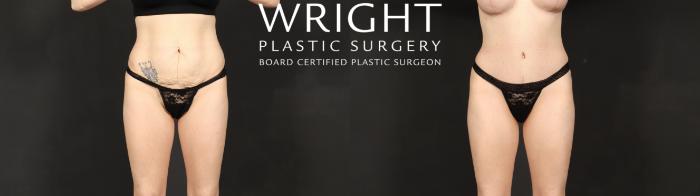 Before & After Tummy Tuck Case 595 Front View in Little Rock, Arkansas