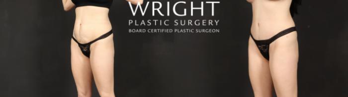 Before & After Tummy Tuck Case 595 Left Oblique View in Little Rock, Arkansas