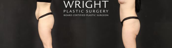 Before & After Tummy Tuck Case 595 Left Side View in Little Rock, Arkansas