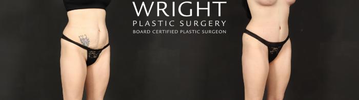Before & After Tummy Tuck Case 595 Right Oblique View in Little Rock, Arkansas