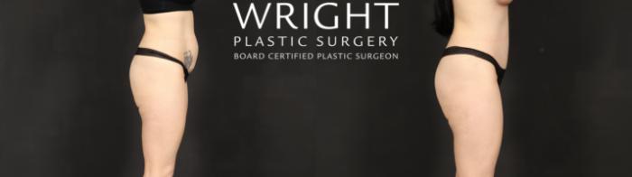 Before & After Tummy Tuck Case 595 Right Side View in Little Rock, Arkansas