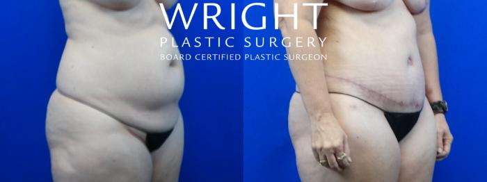 Before & After Tummy Tuck Case 6 Right Oblique View in Little Rock, Arkansas
