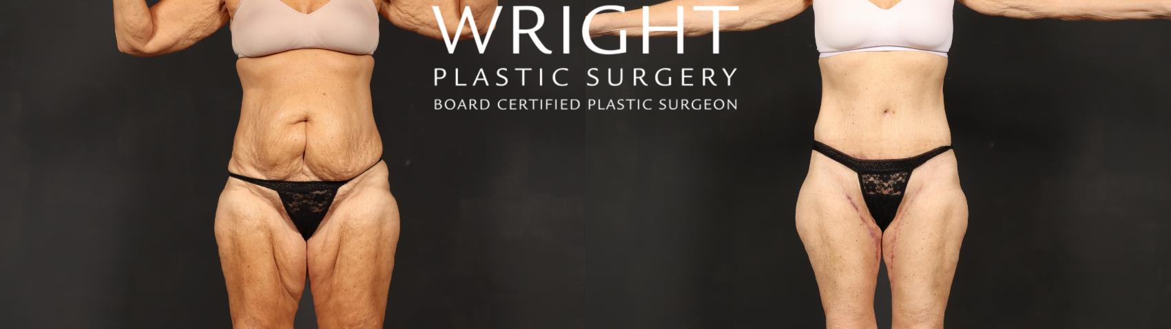 Before & After Tummy Tuck Case 601 Front View in Little Rock, Arkansas