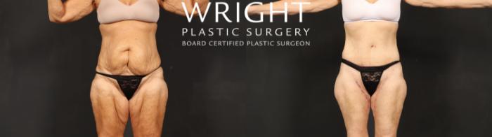 Before & After Tummy Tuck Case 601 Front View in Little Rock, Arkansas