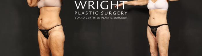 Before & After Tummy Tuck Case 601 Left Oblique View in Little Rock, Arkansas