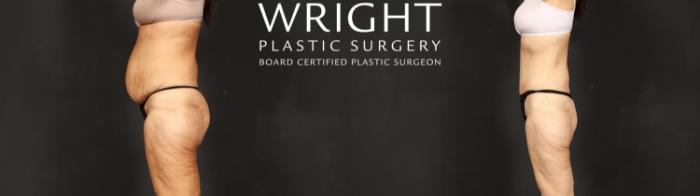 Before & After Tummy Tuck Case 601 Left Side View in Little Rock, Arkansas