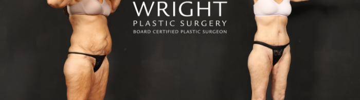 Before & After Tummy Tuck Case 601 Right Oblique View in Little Rock, Arkansas