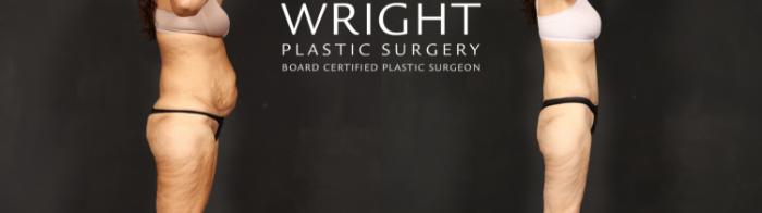 Before & After Tummy Tuck Case 601 Right Side View in Little Rock, Arkansas