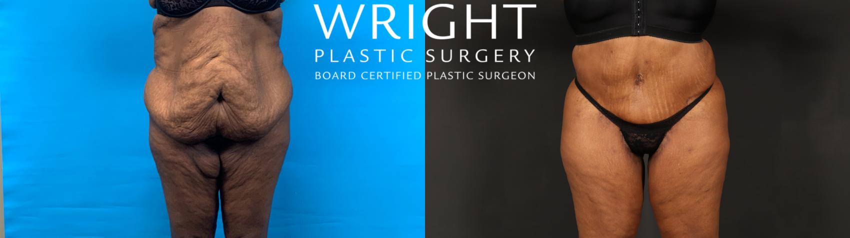 Before & After Tummy Tuck Case 602 Front View in Little Rock, Arkansas