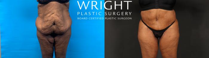 Before & After Tummy Tuck Case 602 Front View in Little Rock, Arkansas