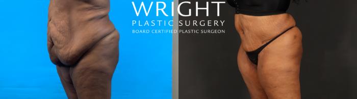 Before & After Tummy Tuck Case 602 Left Oblique View in Little Rock, Arkansas