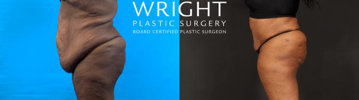 Before & After Tummy Tuck Case 602 Left Side View in Little Rock, Arkansas