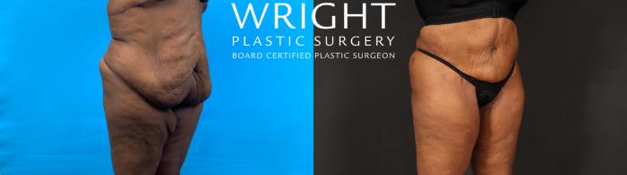 Before & After Tummy Tuck Case 602 Right Oblique View in Little Rock, Arkansas