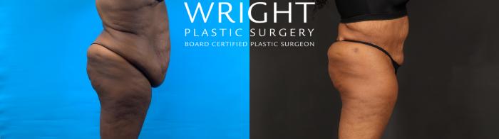 Before & After Tummy Tuck Case 602 Right Side View in Little Rock, Arkansas