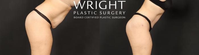 Before & After Tummy Tuck Case 607 Abdominal bend View in Little Rock, Arkansas