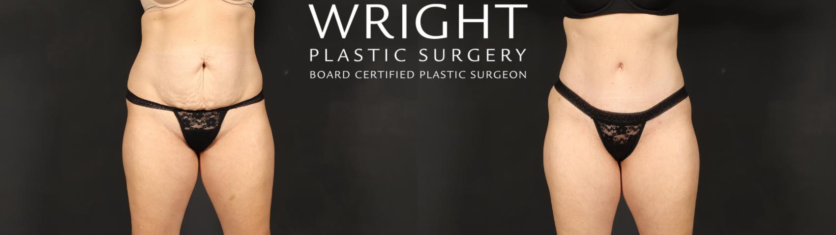 Before & After Tummy Tuck Case 607 Front View in Little Rock, Arkansas