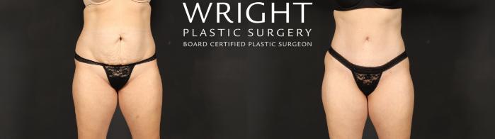 Before & After Tummy Tuck Case 607 Front View in Little Rock, Arkansas