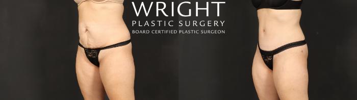 Before & After Tummy Tuck Case 607 Left Oblique View in Little Rock, Arkansas