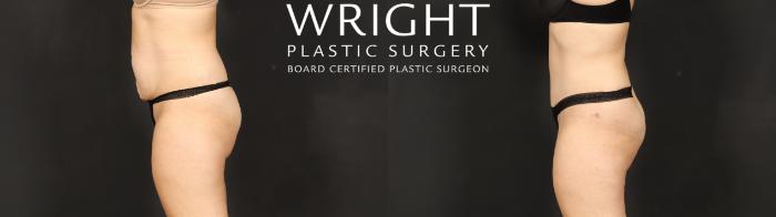 Before & After Tummy Tuck Case 607 Left Side View in Little Rock, Arkansas