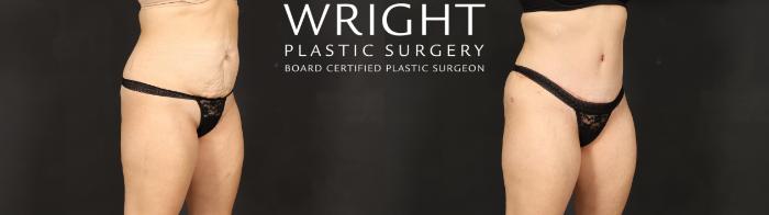 Before & After Tummy Tuck Case 607 Right Oblique View in Little Rock, Arkansas