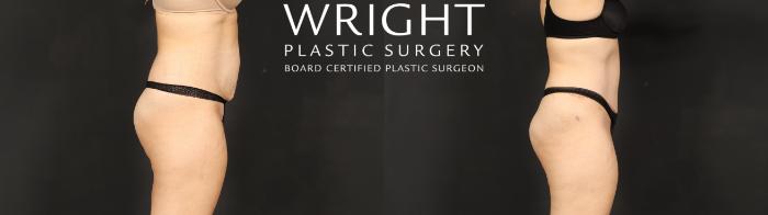 Before & After Tummy Tuck Case 607 Right Side View in Little Rock, Arkansas