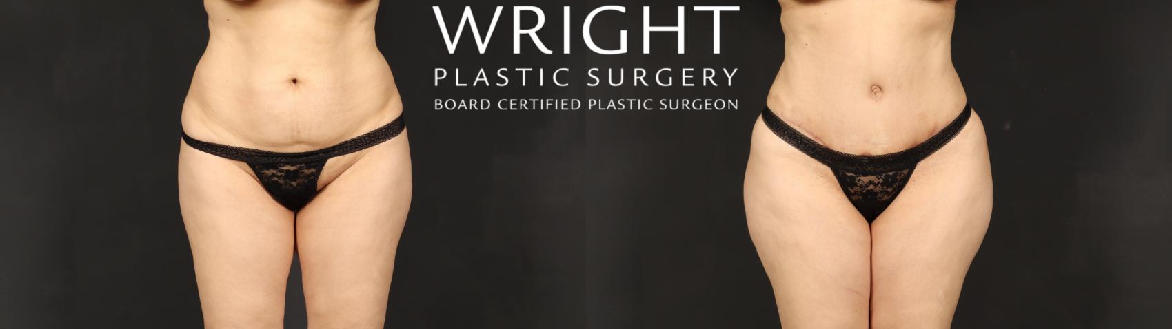 Before & After Tummy Tuck Case 609 Front View in Little Rock, Arkansas