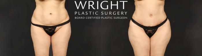 Before & After Tummy Tuck Case 609 Front View in Little Rock, Arkansas