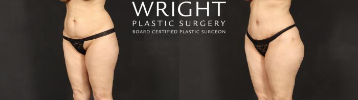 Before & After Tummy Tuck Case 609 Left Oblique View in Little Rock, Arkansas